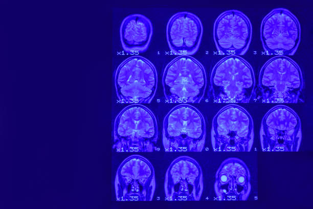 resonancia magnética del cerebro sobre un fondo negro con retroiluminación azul. lugar izquierdo para la inscripción publicitaria - artificial true exam blue fotografías e imágenes de stock