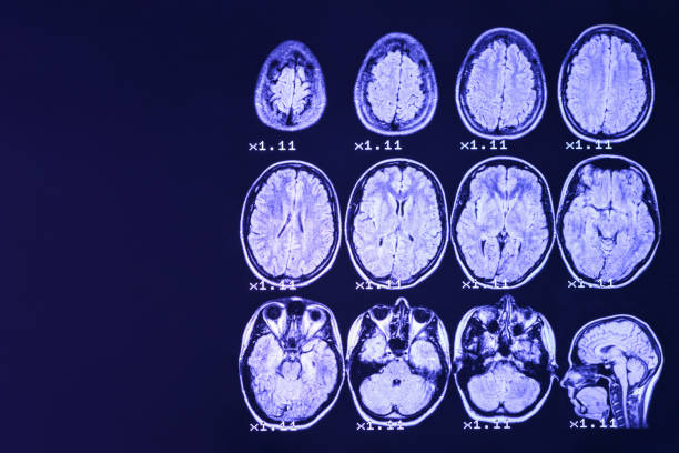 mri do cérebro em um fundo preto com luminoso azul. lugar direito para anunciar a inscrição - brain mri scanner mri scan medical scan - fotografias e filmes do acervo