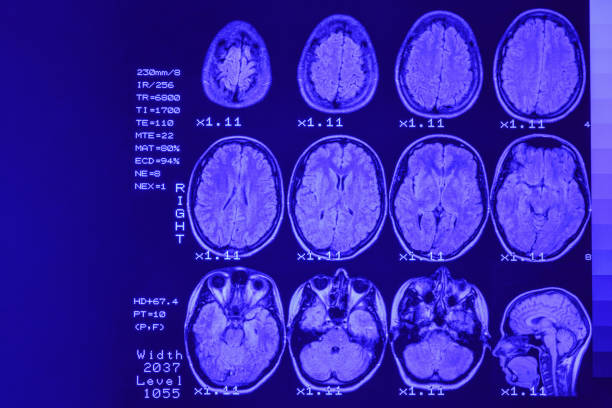 rmn o imagen de resonancia magnética de la cabeza y el escáner cerebral. el resultado es una resonancia magnética del cerebro con valores y números con retroiluminación azul. - artificial true exam blue fotografías e imágenes de stock