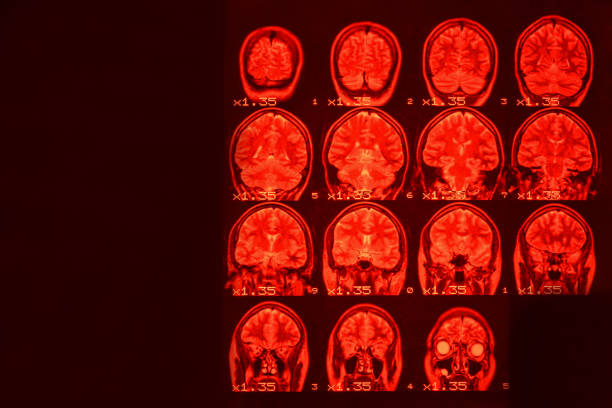 mri do cérebro em um fundo preto com luminoso vermelho. fundo médico - medical equipment mri scanner mri scan hospital - fotografias e filmes do acervo