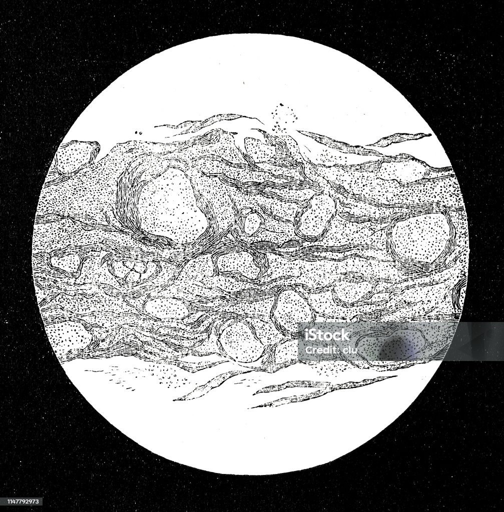 Diphteristis bacterium uner the microscope Illustration from 19th century 19th Century stock illustration