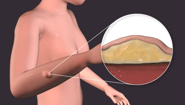 lipoma, un crecimiento de tejido graso bajo la piel humana - human tissue histology dermatology human skin fotografías e imágenes de stock