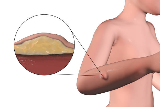 lipoma, un crecimiento de tejido graso bajo la piel humana - human tissue histology dermatology human skin fotografías e imágenes de stock