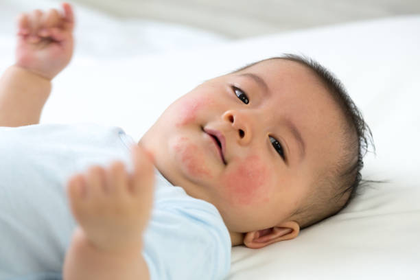 嬰兒對面部有過敏反應, 嬰兒皮疹的概念 - 濕疹 個照片及圖片檔