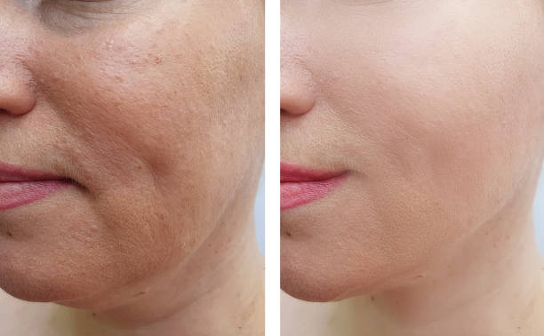 woman face wrinkles before and after correction woman face wrinkles before and after correction botox before and after stock pictures, royalty-free photos & images