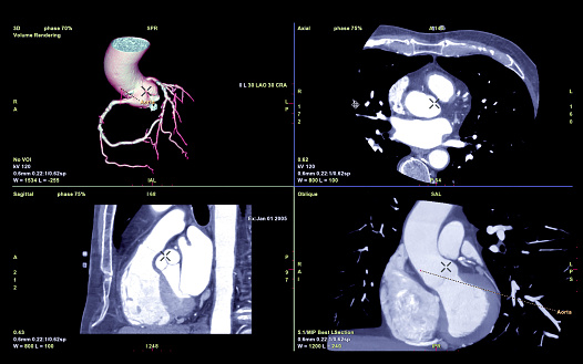 CTA arteria coronaria 3D imagen de renderizado o árbol coronario con visión axial, sagital y coronal para el diagnóstico de estenosis de la arteria coronaria del recipiente. photo