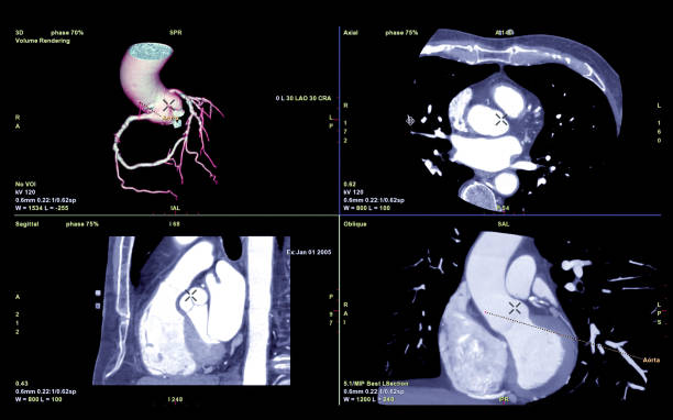 istock CTA Coronary artery  3D rendering image or coronary tree with axial , sagittal and coronal view  for diagnosis of vessel coronary artery stenosis . 1148013840
