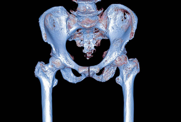 股関節の診断骨折のための両股関節3d レンダリング画像を用いた骨盤骨の ct スキャン。 - cat scan pelvis hip human spine ストックフォトと画像
