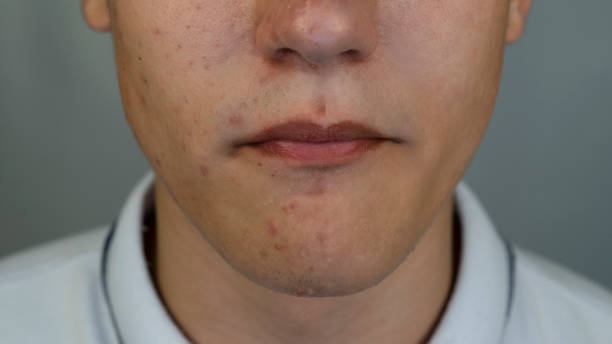 istock Boy with pimples and acne on the face. Close up 1148017396