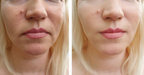istock woman wrinkles face before and after correction 1148044815