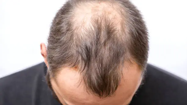Photo of Balding young man, Hair loss problem