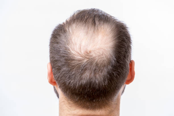 bald mann hat ein problem der kopfklatte und haarausfall - geheimratsecke stock-fotos und bilder