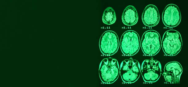 banner. mri of the brain of a healthy person on a black background with green  backlight. left   place for advertising inscription - brain mri scanner mri scan medical scan imagens e fotografias de stock