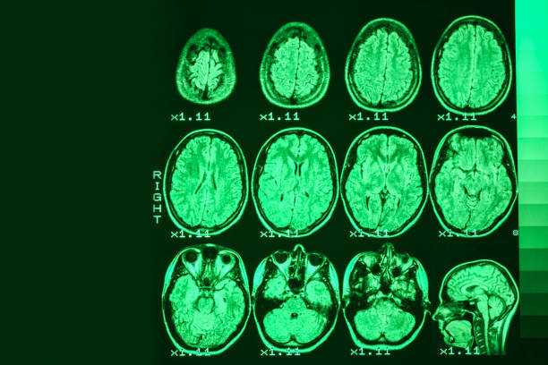 mri of the brain of a healthy person on a black background with green  backlight. left   place for advertising inscription - brain mri scanner mri scan medical scan imagens e fotografias de stock