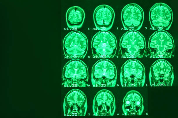 mri do cérebro de uma pessoa saudável em um fundo preto com luminoso verde. lugar esquerdo para anunciar a inscrição - medical equipment mri scanner mri scan hospital - fotografias e filmes do acervo
