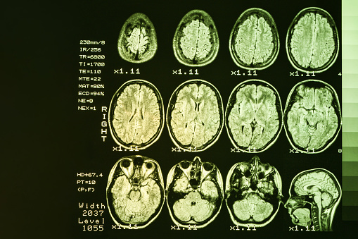MRI scan or magnetic resonance image of head and brain scan. The result is an MRI of the brain with values and numbers with yellow backlight.