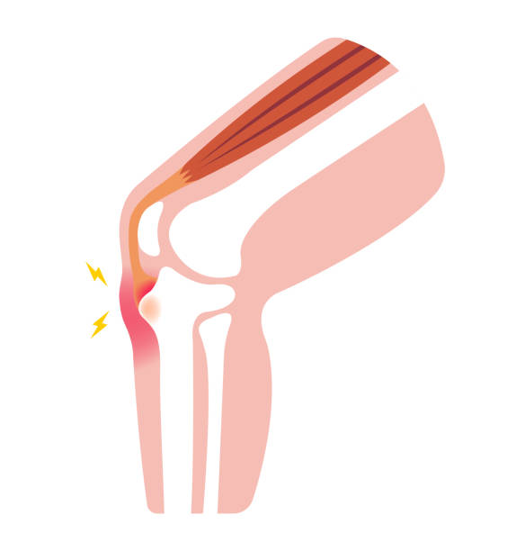 osgood-schlatter 질병 (무릎 관절 질환) 그림 (텍스트 없음) - cartilage patella human knee medical exam stock illustrations