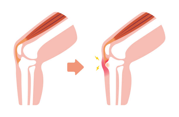 380 Knee Bursitis Stock Photos Pictures Royalty Free Images IStock 380-knee-bursitis-stock-photos-pictures-royalty-free-images-istock