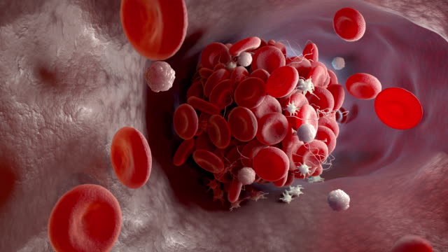 1,677 Blood Clot Stock Videos and Royalty-Free Footage - iStock | Blood  cells, Pulmonary embolism, Blood