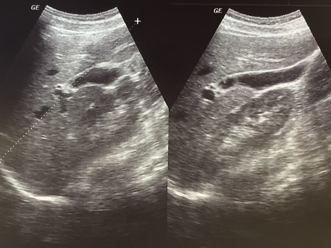 Ultrasound image of human liver and gall gladder