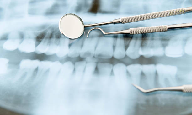 dental x-ray and tools background - human teeth healthcare and medicine medicine equipment imagens e fotografias de stock