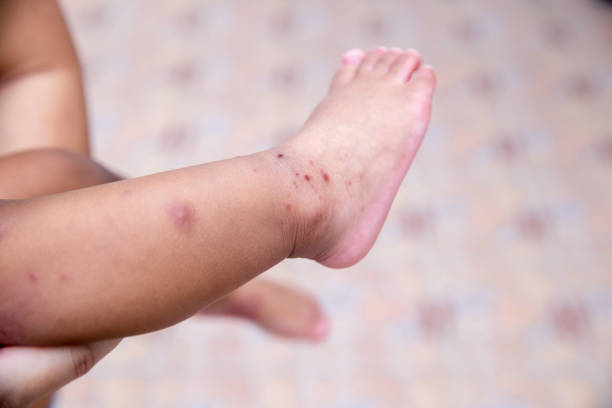 Boy with symptoms hand, foot and mouth disease . children "  HFMD " with disease .Mouth Foot and Mouth Disease caused by a strain of Coxsackie virus. stock photo