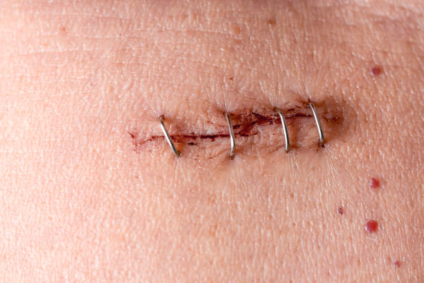 istock Metal staples (satures) in a scar left from a laparoscopy 1148690299