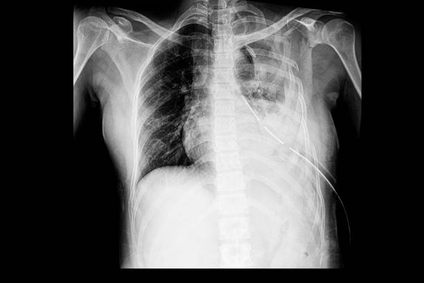 A chest xray film of a patient with multiple left rib fractures A chest xray film of a patient with multiple left rib fractures with left side large hemothorax and an intrathoracic drainage tube (ICD).  Chest radiology image in trauma and accident. Flail chest. rib cage stock pictures, royalty-free photos & images