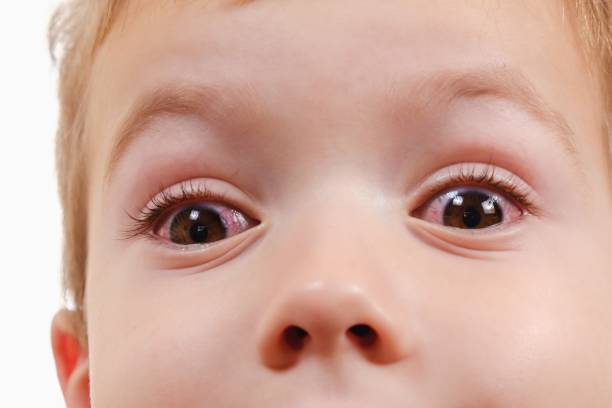 istock Child conjunctivitis red eye with infection,   virus. 1148807264