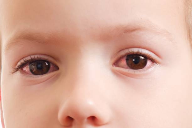 Child conjunctivitis red eye with infection,   health. stock photo