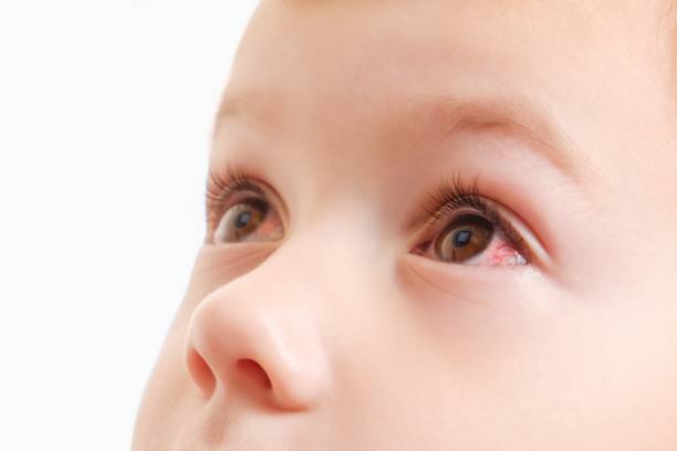 Child conjunctivitis red eye with infection,   illness. stock photo