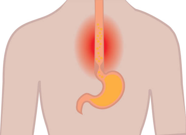 istock Gastroesophageal reflux desease. Heartburn  Gerd stomach  in a human body vector illustration 1148808691