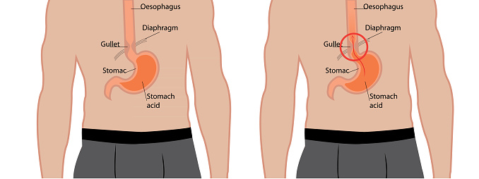 Gerd Body System Gastroesophageal Reflux Desease Gerd Stomach In A Human Body Vector ...