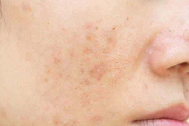 istock Acne scars and pores. Dark spots. 1148989301
