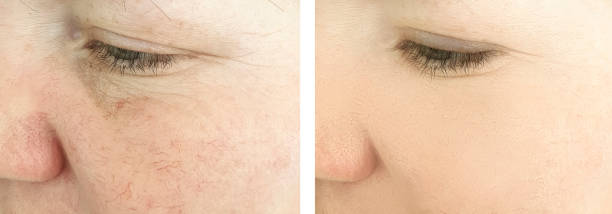 istock woman wrinkles face before and after procedures, rosacea 1149093358
