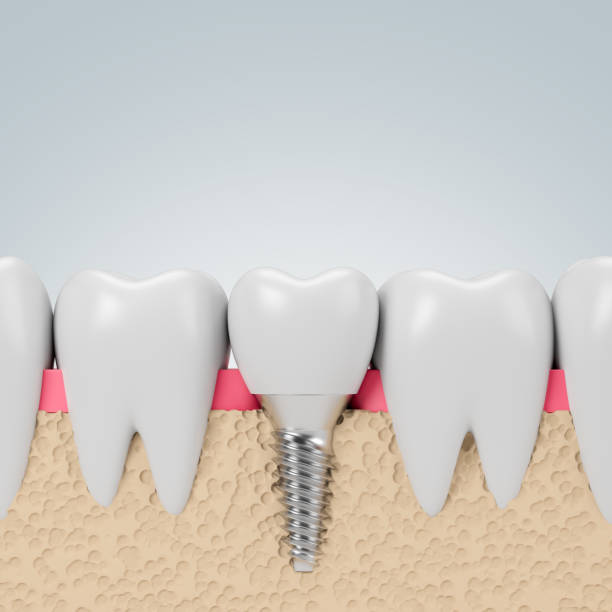 istock Teeth with implant screw, gray background 1149136385