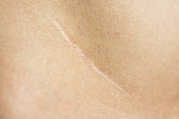 cerca, hermosa cicatriz quirúrgica en la piel después de la apendicectomía - scar fotografías e imágenes de stock