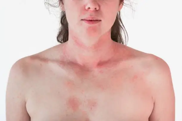 Strong allergic skin reaction on the female neck and face - red rash