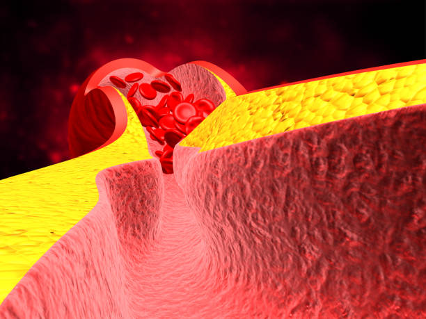 istock Arteries swelling because fat cloged made blood flow slowly 1149383867