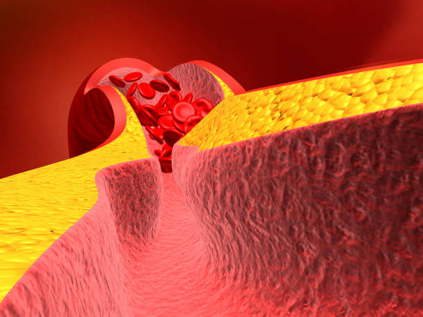 istock Arteries swelling because fat cloged made blood flow slowly 1149385566