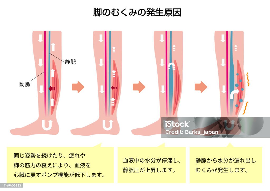 Cause of swelling(edema) of the legs. flat illustration (Japanese / with explanation text). Anatomy stock vector