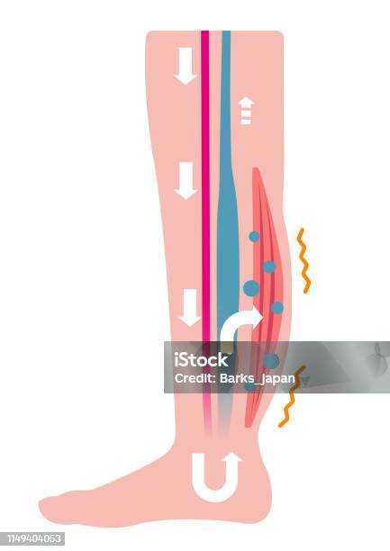 Cause Of Swelling Stock Illustration - Download Image Now