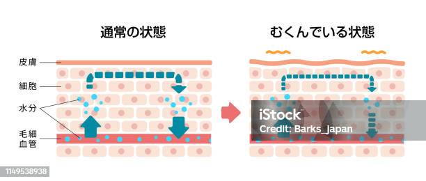 Comparison Illustration Of Normal Skin And Swollen Skin Stock Illustration - Download Image Now