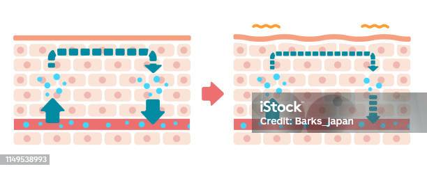 Comparison Illustration Of Normal Skin And Swollen Skin Stock Illustration - Download Image Now