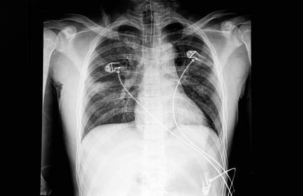 A chest x-ray of a patient with dyspne
