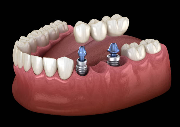 зубной мост поддерживается имплантатами. медицинская точная 3d иллюстрация человеческих зубов и протезов концепции - implantat стоковые фото и изображения