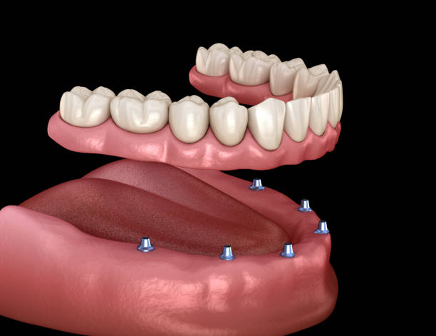 mandibular prosthesis with gum all on 6 system supported by implants.  medically accurate 3d illustration of human teeth and dentures concept - implantat imagens e fotografias de stock