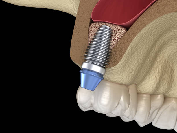 sinus lift surgery - implant installation. 3d illustration - implantat imagens e fotografias de stock