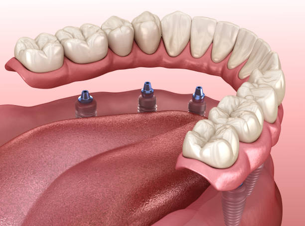 manandibuläre prothese mit kaugummi all on 6 system unterstützt durch implantate.  medizinisch genaue 3d-illustration des menschlichen zähne- und prothesenkonzepts - dentures stock-fotos und bilder