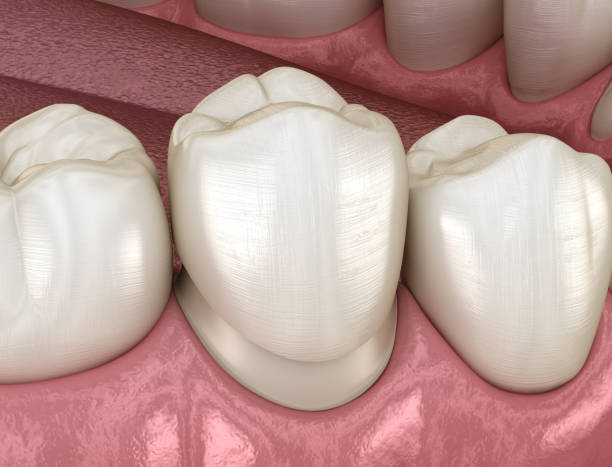 istock Preparated premolar tooth for dental crown placement. Medically accurate 3D illustration 1149710042